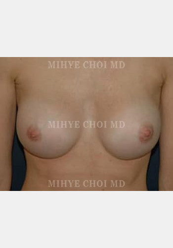 After Image: Breast Augmentation – Case 3 - front