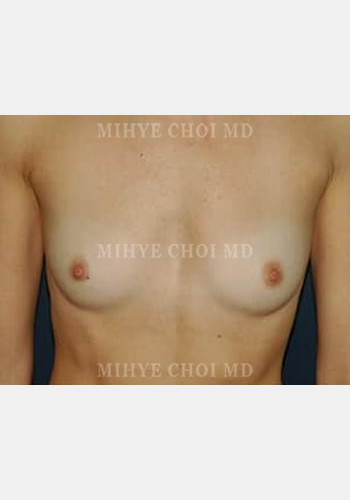 Before Image: Breast Augmentation – Case 3 - front