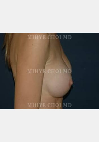 After Image: Breast Augmentation – Case 3 - other