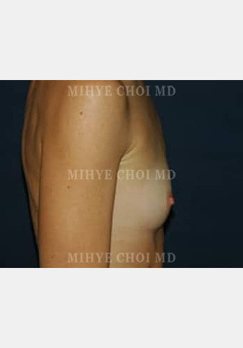 Before Image: Breast Augmentation – Case 3 - other