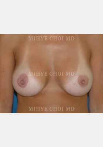 Breast Augmentation – Case 4