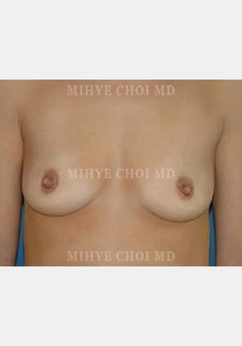 Breast Augmentation – Case 4