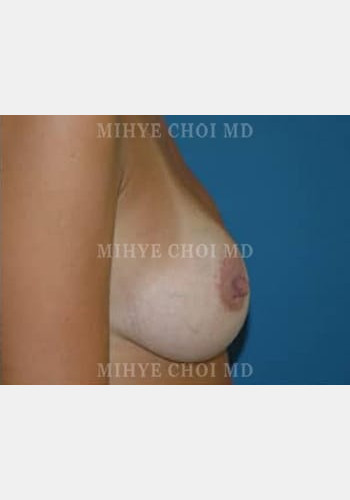 After Image: Breast Augmentation – Case 4 - other