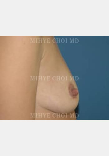 Before Image: Breast Augmentation – Case 4 - other