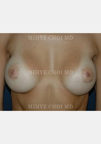 Breast Augmentation – Case 5