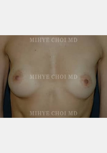 Breast Augmentation – Case 5