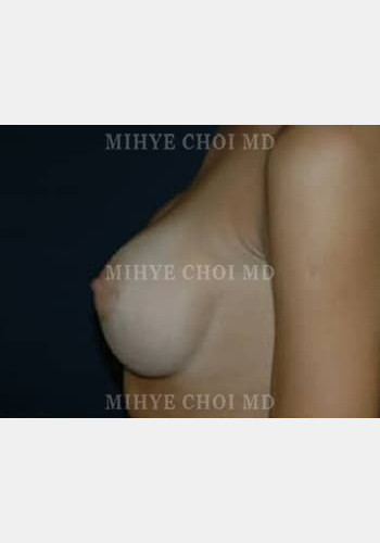 After Image: Breast Augmentation – Case 5 - other