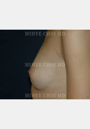 Before Image: Breast Augmentation – Case 5 - other