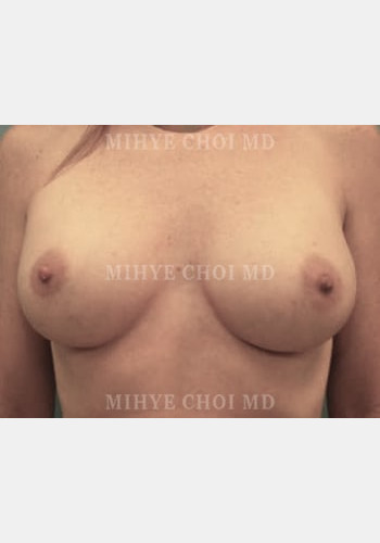 After Image: Breast Augmentation – Case 6 - front