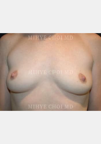 Before Image: Breast Augmentation – Case 6 - front