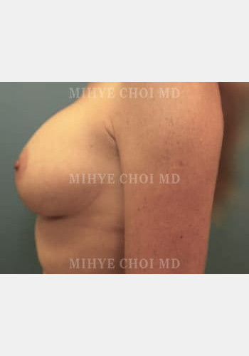 After Image: Breast Augmentation – Case 6 - left-side