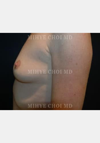 Before Image: Breast Augmentation – Case 6 - left-side