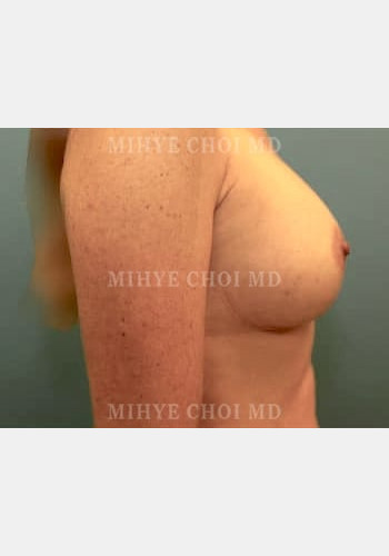 After Image: Breast Augmentation – Case 6 - right-side