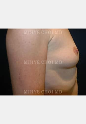 Before Image: Breast Augmentation – Case 6 - right-side