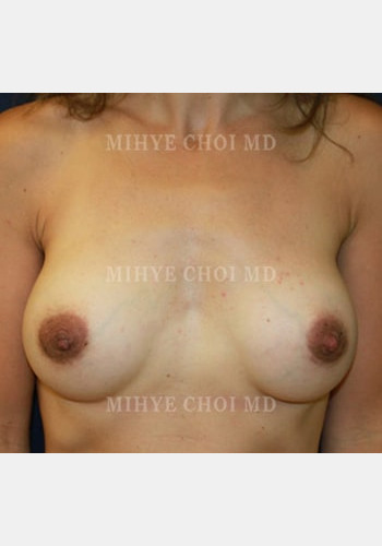 After Image: Breast Augmentation – Case 7 - front