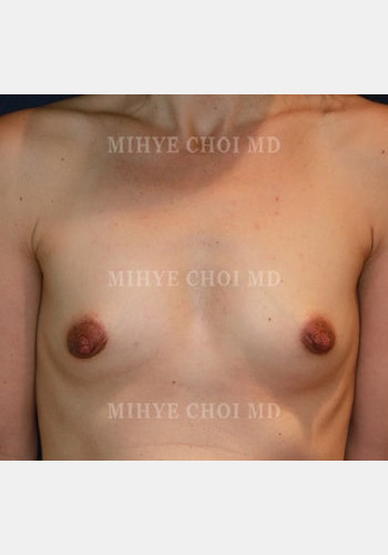 Before Image: Breast Augmentation – Case 7 - front