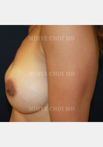 After Image: Breast Augmentation – Case 7 - other
