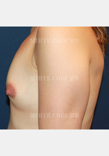 Before Image: Breast Augmentation – Case 7 - other