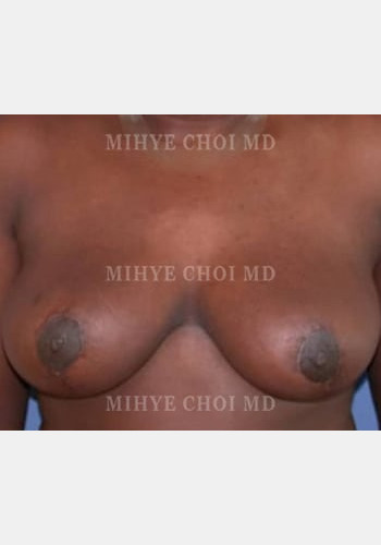 Breast Reduction – Case 2