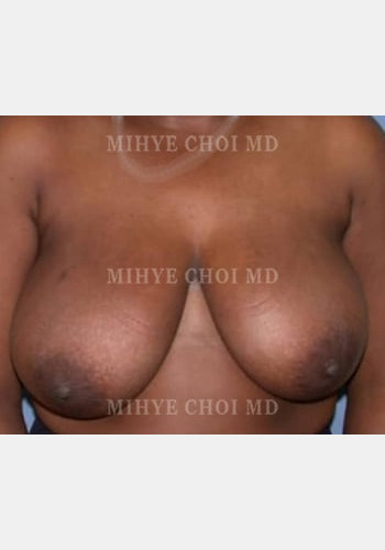 Breast Reduction – Case 2