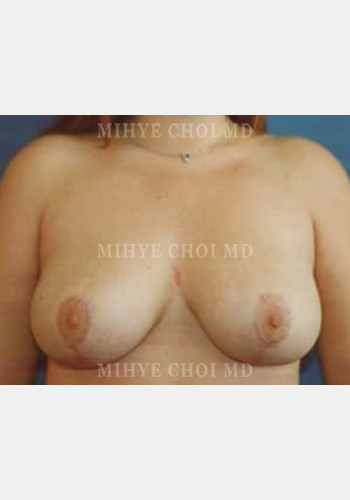 Breast Reduction – Case 3