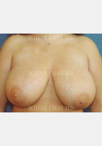 Breast Reduction – Case 3