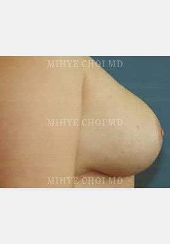 After Image: Breast Reduction – Case 3 - other