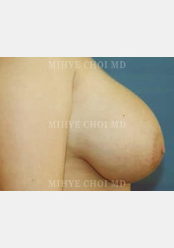 Before Image: Breast Reduction – Case 3 - other