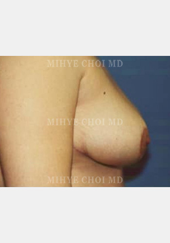 After Image: Breast Reduction – Case 4 - other