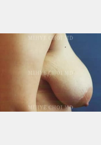 Before Image: Breast Reduction – Case 4 - other
