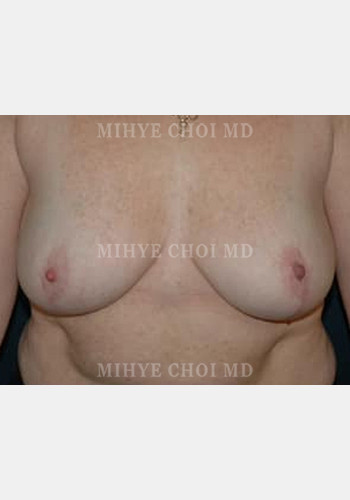 After Image: Breast Reduction – Case 5 - front