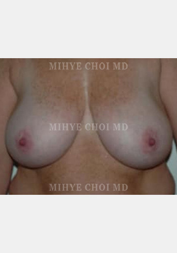 Breast Reduction – Case 5