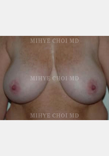 Before Image: Breast Reduction – Case 5 - front