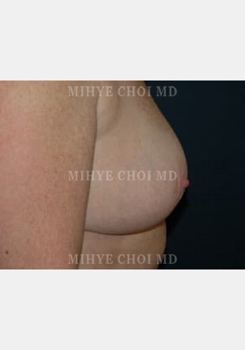 After Image: Breast Reduction – Case 5 - other