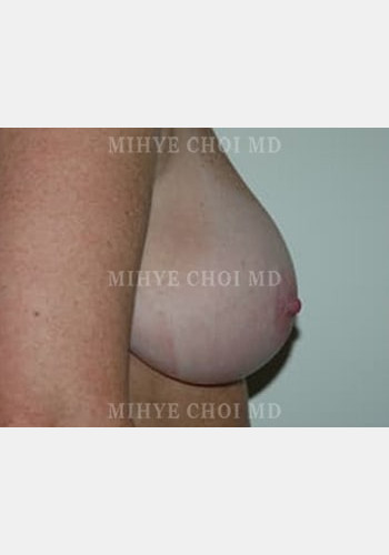 Before Image: Breast Reduction – Case 5 - other