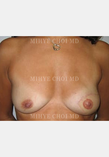 After Image: Flap Breast Reconstruction – Case 1 - front