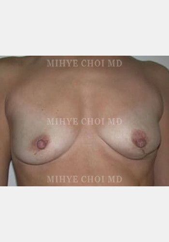 Flap Breast Reconstruction – Case 1