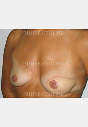After Image: Flap Breast Reconstruction – Case 1 - left-front-oblique