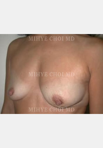 Before Image: Flap Breast Reconstruction – Case 1 - left-front-oblique