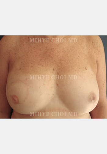 After Image: Flap Breast Reconstruction – Case 2 - front