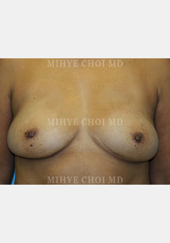After Image: Flap Breast Reconstruction – Case 3 - front