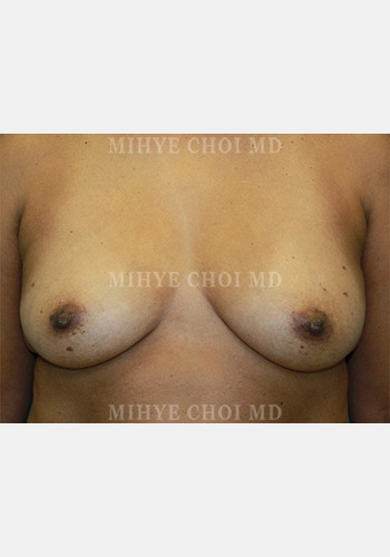 Before Image: Flap Breast Reconstruction – Case 3 - front