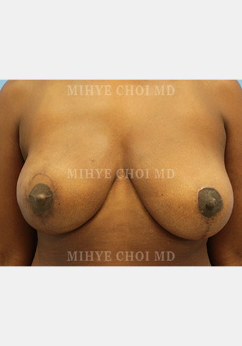 Flap Breast Reconstruction – Case 4