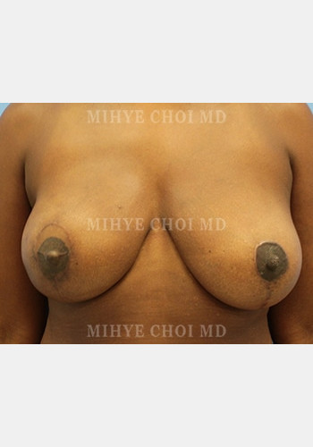After Image: Flap Breast Reconstruction – Case 4 - front