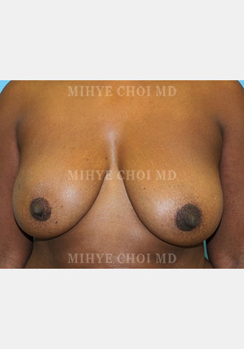 Flap Breast Reconstruction – Case 4