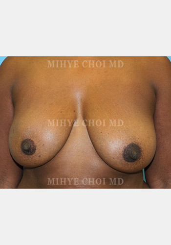 Before Image: Flap Breast Reconstruction – Case 4 - front