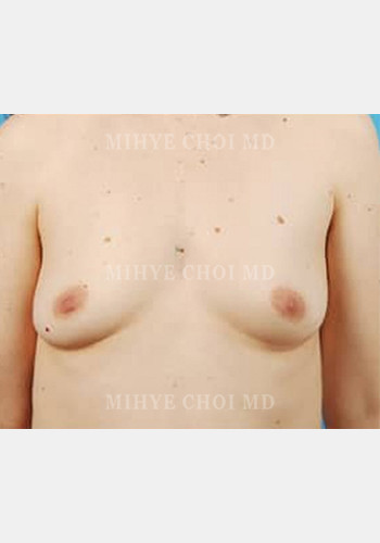 Before Image: Flap Breast Reconstruction – Case 5