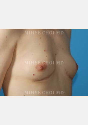 After Image: Flap Breast Reconstruction – Case 5 - right-front-oblique