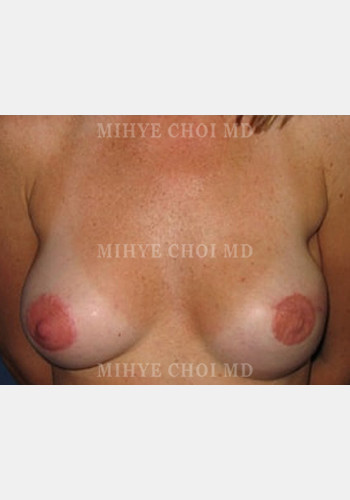 After Image: Implant Breast Reconstruction – Case 1
