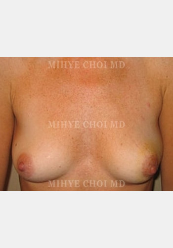 Before Image: Implant Breast Reconstruction – Case 1